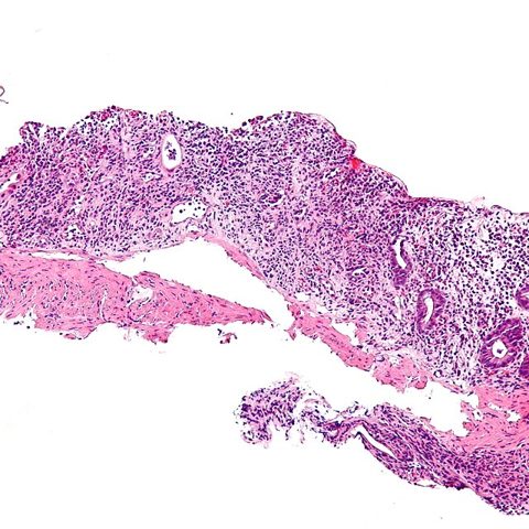 Mpox 2022 (Monkeypox clade IIb) electron micrograph
